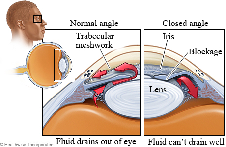 Picture of the structures affected by closed-angle glaucoma