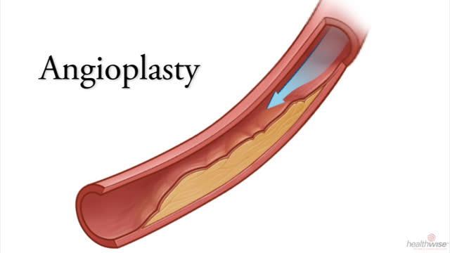 Angioplastia para una enfermedad del corazón
