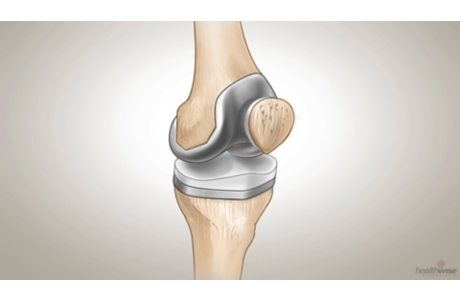 Artroplastia de rodilla