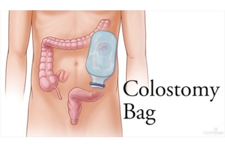 Colostomy