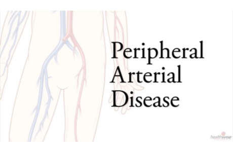 Angioplasty for Peripheral Arterial Disease