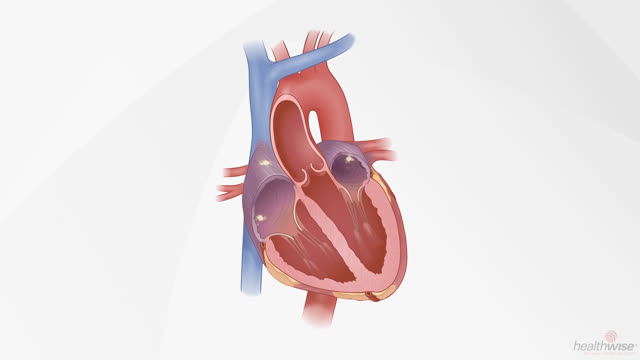 What Is Atrial Fibrillation?