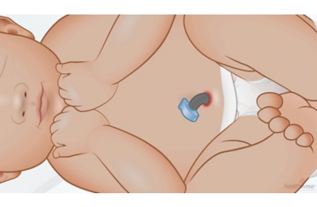 Cómo cuidar a su bebé recién nacido: Cordón umbilical
