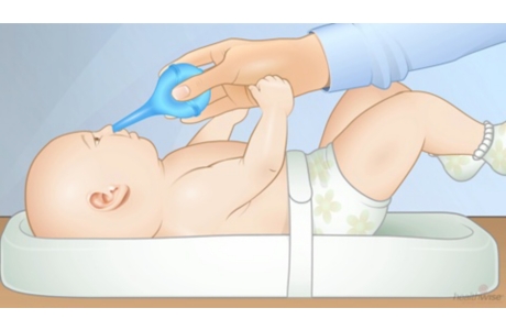 Cómo usar una pera de goma para limpiar la nariz de un bebé