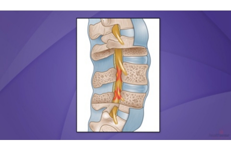 Back Surgery for Spinal Stenosis