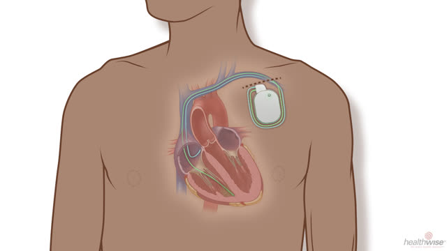 Arritmia: ¿Qué es un desfibrilador cardioversor implantable? (subtitulado)