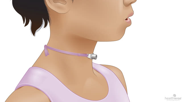 Caring for Your Child's Trach