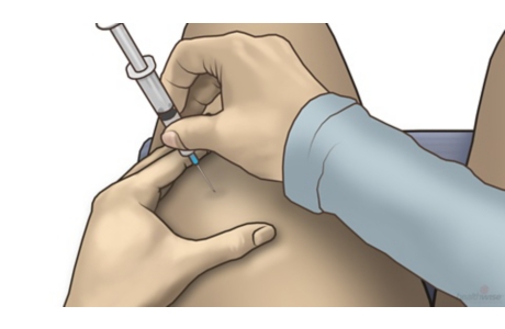 How to Give an Intramuscular Injection