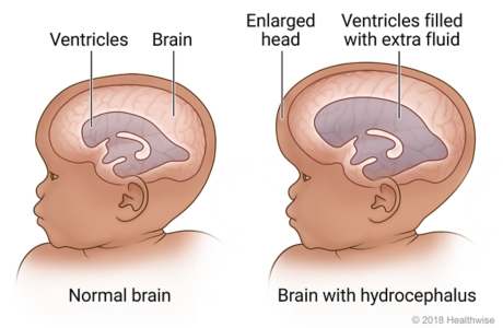 Inside views of normal brain of baby and brain with hydrocephalus that shows enlarged head and ventricles filled with extra fluid