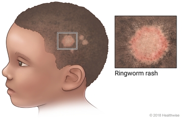 Quick Facts: Scalp Ringworm - MSD Manual Consumer Version