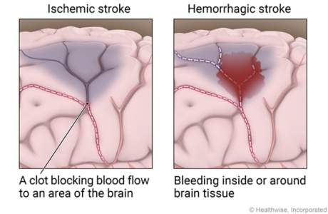 Ischemic stroke showing clot blocking blood clot blocking blood flow to area of brain and a hemorrhagic stroke showing bleeding inside or around brain tissue