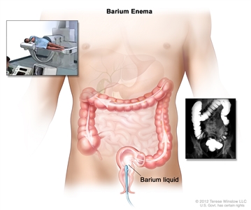 Barium enema procedure; shows barium liquid being put into the rectum and flowing through the colon. Inset shows person on table having a barium enema.