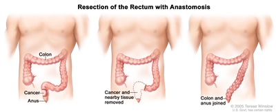 Three-panel drawing showing rectal cancer surgery with anastomosis; first panel shows area of rectum with cancer, middle panel shows cancer and nearby tissue removed, last panel shows the colon and anus joined.