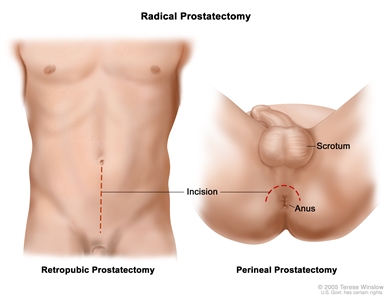 Two panel drawing showing two ways of doing a radical prostatectomy; in the first panel, dotted line shows where incision is made through the wall of the abdomen for a retropubic prostatectomy; in the second panel, dotted line shows where incision is made in area between the scrotum and the anus for a perineal prostatectomy.