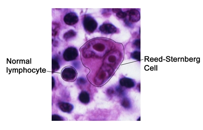 Reed-Sternberg cell; photograph shows normal lymphocytes compared with a Reed-Sternberg cell.
