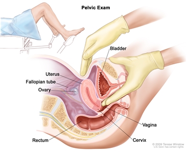 Pelvic exam; drawing shows a side view of the female reproductive anatomy during a pelvic exam. The uterus, left fallopian tube, left ovary, cervix, vagina, bladder, and rectum are shown. Two gloved fingers of one hand of the doctor or nurse are shown inserted into the vagina, while the other hand is shown pressing on the lower abdomen. The inset shows a woman covered by a drape on an exam table with her legs apart and her feet in stirrups.