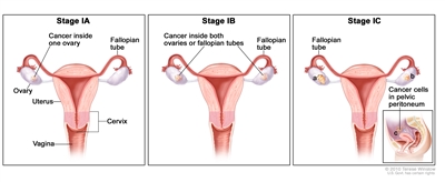Three-panel drawing of stage IA, IB, and IC; the first panel (stage IA) shows cancer inside one ovary. The second panel (stage IB) shows cancer inside both ovaries. The third panel (stage IC) shows cancer inside both ovaries, and one ovary has a ruptured capsule. An inset shows cancer cells in the pelvic peritoneum. Also shown are the fallopian tubes, uterus, cervix, and vagina.