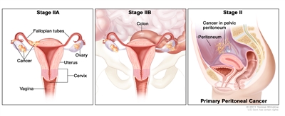 Three-panel drawing of stage IIA, IIB, and stage II primary peritoneal cancer; the first panel (stage IIA) shows cancer inside both ovaries that has spread to the uterus and fallopian tube. The second panel (stage IIB) shows cancer inside both ovaries that has spread to the colon. The third panel (stage II primary peritoneal cancer) shows cancer in the pelvic peritoneum. Also shown are the cervix and vagina.