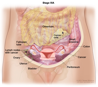 Drawing of stage IIIA shows cancer inside both ovaries that has spread to (a) lymph nodes behind the peritoneum. Also shown is (b) microscopic cancer cells that have spread to the omentum. The small intestine, colon, fallopian tubes, uterus, and bladder are also shown.