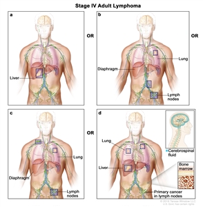 Stage IV adult lymphoma; drawing shows four panels: (a) the top left panel shows cancer in the liver; (b) the top right panel shows cancer in the left lung and in two groups of lymph nodes below the diaphragm; (c) the bottom left panel shows cancer in the left lung and in a group of lymph nodes above the diaphragm and below the diaphragm; and (d) the bottom right panel shows cancer in both lungs, the liver, and the bone marrow (pullout). Also shown is primary cancer in the lymph nodes and a pullout of the brain with cerebrospinal fluid (in blue).