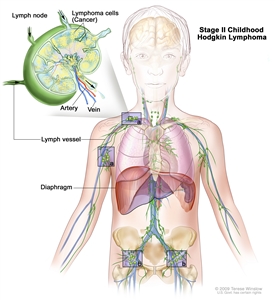 Stage II childhood Hodgkin lymphoma; drawing shows cancer in lymph node groups above and below the diaphragm. An inset shows a lymph node with a lymph vessel, an artery, and a vein. Lymphoma cells containing cancer are shown in the lymph node.