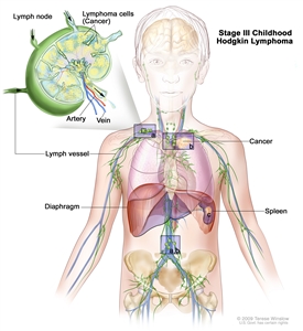Stage III childhood Hodgkin lymphoma; drawing shows cancer in lymph node groups above and below the diaphragm, in the left lung, and in the spleen. An inset shows a lymph node with a lymph vessel, an artery, and a vein. Lymphoma cells containing cancer are shown in the lymph node.