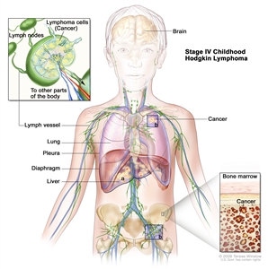 Stage IV childhood Hodgkin lymphoma; drawing shows cancer in the liver, the left lung, and in one lymph node group below the diaphragm. The brain and pleura are also shown. One inset shows cancer spreading through lymph nodes and lymph vessels to other parts of the body. Lymphoma cells containing cancer are shown inside one lymph node. Another inset shows cancer cells in the bone marrow.