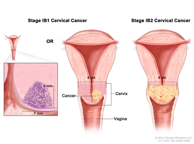 Stage IB1 and IB2 cervical cancer shown in three cross-section drawings of the cervix and vagina. An inset on the left shows stage IB1 cancer that is 7 mm wide and more than 5 mm deep. Drawing in the middle shows stage IB1 cancer that is smaller than 4 cm. Drawing on the right shows stage IB2 cancer that is larger than 4 cm.