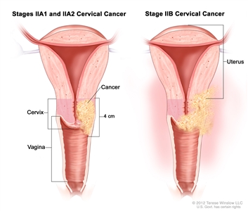 Stage II cervical cancer; drawing shows a cross-section of the uterus, cervix and vagina. In stages IIA1 and IIA2, cancer that is 4 cm is shown in the cervix and in the upper third of the vagina. In stage IIB, cancer is shown in the cervix, the upper two thirds of the vagina, and in the tissues around the uterus.