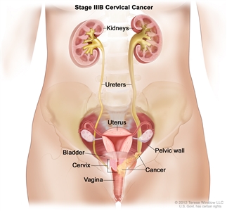 Stage IIIB cervical cancer; drawing shows cancer in the cervix, the vagina, and the pelvic wall, blocking the ureter on the right. The uterus and kidneys are also shown.