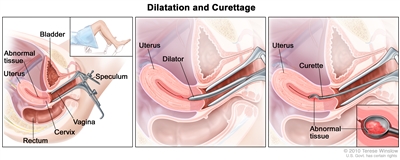 Dilatation and curettage (D and C). Three-panel drawing showing a side view of the female reproductive anatomy during a D and C procedure. The first panel shows a speculum widening the opening of the vagina. The cervix, uterus with abnormal tissue, bladder, and rectum are also shown; an inset shows the lower half of a woman covered by a drape on an exam table with her legs apart and her feet in stirrups. The middle panel shows the uterus and a dilator inserted through the vagina into the cervix. The third panel shows a curette scraping out abnormal tissue from the uterus; an inset shows a close up of the curette with the abnormal tissue in it.