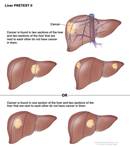 Liver PRETEXT II; drawing shows five livers. Dotted lines divide each liver into four vertical sections that are about the same size. In the first liver, cancer is shown in the two sections on the left. In the second liver, cancer is shown in the two sections on the right. In the third liver, cancer is shown in the far left and far right sections. In the fourth liver, cancer is shown in the second section from the left. In the fifth liver, cancer is shown in the second section from the right.