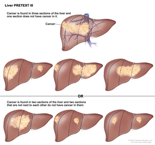 Liver PRETEXT III; drawing shows seven livers. Dotted lines divide each liver into four vertical sections that are about the same size. In the first liver, cancer is shown in three sections on the left. In the second liver, cancer is shown in the two sections on the left and the section on the far right. In the third liver, cancer is shown in the section on the far left and the two sections on the right. In the fourth liver, cancer is shown in three sections on the right. In the fifth liver, cancer is shown in the two middle sections. In the sixth liver, cancer is shown in the section on the far left and the second section from the right. In the seventh liver, cancer is shown in the section on the far right and the second section from the left.