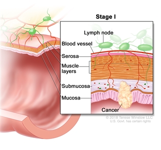 Stage I colorectal cancer; drawing shows a cross-section of the colon/rectum. An inset shows the layers of the colon/rectum wall with cancer in the mucosa and submucosa. Also shown are the muscle layers, serosa, a blood vessel, and lymph nodes.