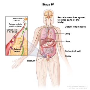 Stage IV rectal cancer; drawing shows other parts of the body where rectal cancer may spread, including the distant lymph nodes, lung, liver, abdominal wall, and ovary. An inset shows cancer cells spreading from the rectum, through the blood and lymph system, to another part of the body where metastatic cancer has formed.