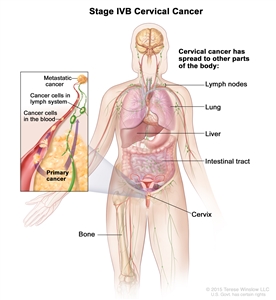 Stage IVB cervical cancer; drawing shows other parts of the body where cervical cancer may spread, including the lymph nodes, lung, liver, intestinal tract, and bone. An inset shows cancer cells spreading from the cervix, through the blood and lymph system, to another part of the body where metastatic cancer has formed.