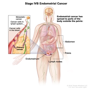 Stage IVB endometrial cancer; drawing shows cancer has spread to parts of the body outside the pelvis, including the abdomen and/or lymph nodes in the groin. An inset shows cancer cells spreading from the endometrium, through the blood and lymph system, to another part of the body where metastatic cancer has formed.