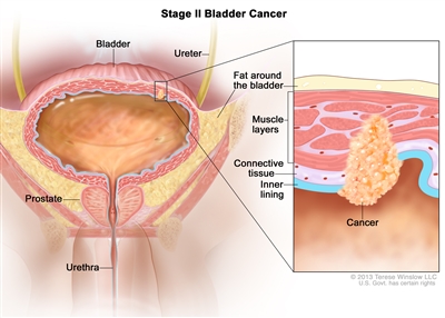 Stage II bladder cancer; drawing shows the bladder, ureter, prostate, and urethra. Inset shows cancer in the inner lining of the bladder, the layer of connective tissue, and the muscle layers. Also shown is the layer of fat around the bladder.