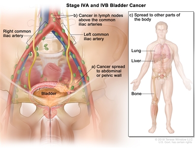 Stage IVA and IVB bladder cancer; drawing shows cancer that has spread from the bladder to (a) the abdominal or pelvic wall and (b) lymph nodes above the common iliac arteries. Also shown is cancer that has spread to (c) other parts of the body, including the lung, liver, and bone.