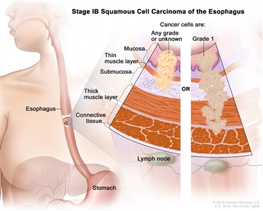 Stage IB squamous cell cancer of the esophagus; drawing shows the esophagus and stomach. A two-panel inset shows the layers of the esophagus wall: the mucosa layer, thin muscle layer, submucosa layer, thick muscle layer, and connective tissue layer. The lymph nodes are also shown. The left panel shows cancer cells that are any grade or of an unknown grade in the mucosa layer, thin muscle layer, and submucosa layer. The right panel shows grade 1 cancer cells in the mucosa layer, thin muscle layer, submucosa layer, and thick muscle layer.