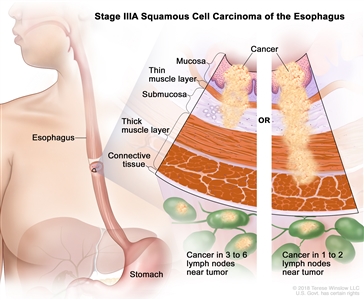 Stage IIIA squamous cell cancer of the esophagus; drawing shows the esophagus and stomach. A two-panel inset shows the layers of the esophagus wall: the mucosa layer, thin muscle layer, submucosa layer, thick muscle layer, and connective tissue layer. The left panel shows cancer in the mucosa layer, thin muscle layer, and submucosa layer and in 3 lymph nodes near the tumor. The right panel shows cancer in the mucosa layer, thin muscle layer, submucosa layer, and thick muscle layer and in 1 lymph node near the tumor.