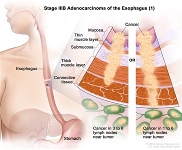 Stage IIIB adenocarcinoma of the esophagus (1); drawing shows the esophagus and stomach. An inset shows the layers of the esophagus wall: the mucosa layer, thin muscle layer, submucosa layer, thick muscle layer, and connective tissue layer. The left panel shows cancer in the mucosa layer, thin muscle layer, submucosa layer, and thick muscle layer and in 3 lymph nodes near the tumor. The right panel shows cancer in the mucosa layer, thin muscle layer, submucosa layer, thick muscle layer, and connective tissue layer and in 4 lymph nodes near the tumor.