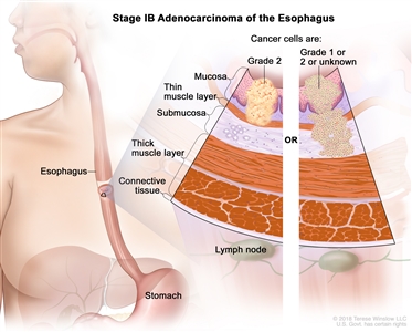 Stage IB adenocarcinoma of the esophagus; drawing shows the esophagus and stomach. A two-panel inset shows the layers of the esophagus wall: the mucosa layer, thin muscle layer, submucosa layer, thick muscle layer, and connective tissue layer. The lymph nodes are also shown. The left panel shows grade 2 cancer cells in the mucosa layer and thin muscle layer. The right panel shows cancer cells in the mucosa layer, thin muscle layer, and submucosa layer. The cancer cells are grade 1 or 2 or the grade is not known.