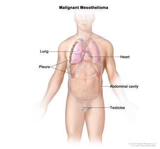 Malignant mesothelioma; drawing shows parts of the body where malignant mesothelioma may form, including the lungs, heart, pleura, abdominal cavity, and testicles.