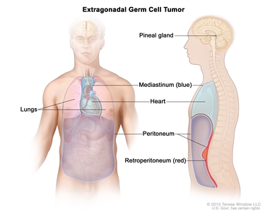 Extragonadal germ cell tumor; drawing shows parts of the body where extragonadal germ cell tumors may form, including the pineal gland in the brain, the mediastinum (the area between the lungs), and the retroperitoneum (the area behind the abdominal organs). Also shown are the heart and peritoneum.