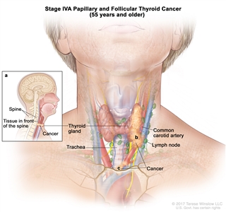 Stage IVA papillary and follicular thyroid cancer in patients 55 years and older; drawing shows cancer has (a) spread to tissue in front of the spine, (b) surrounded the common carotid artery, and (c) surrounded the blood vessels in the area between the lungs. Also shown are the thyroid gland, trachea, and lymph nodes.