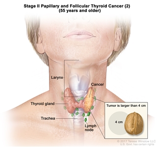 Stage II papillary and follicular thyroid cancer (2) in patients 55 years and older; drawing shows cancer in the thyroid gland and the tumor is larger than 4 centimeters. An inset shows 4 centimeters is about the size of a walnut. Also shown are the lymph nodes, larynx, and trachea.