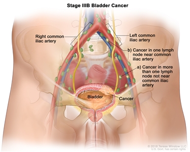 Stage IIIB bladder cancer; drawing shows cancer in the bladder and in (a) more than one lymph node not near the common iliac artery and (b) one lymph node near the common iliac artery. Also shown are the right and left common iliac arteries.