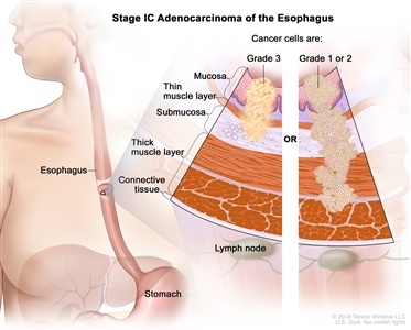 Stage IC adenocarcinoma of the esophagus; drawing shows the esophagus and stomach. A two-panel inset shows the layers of the esophagus wall: the mucosa layer, thin muscle layer, submucosa layer, thick muscle layer, and connective tissue layer. The lymph nodes are also shown. The left panel shows grade 3 cancer cells in the mucosa layer, thin muscle layer, and submucosa layer. The right panel shows grade 1 or 2 cancer cells in the mucosa layer, thin muscle layer, submucosa layer, and thick muscle layer.