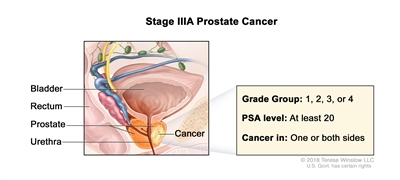 Stage IIIA prostate cancer; drawing shows cancer in one side of the prostate. The PSA level is at least 20 and the Grade Group is 1, 2, 3, or 4. Also shown are the bladder, rectum, and urethra.